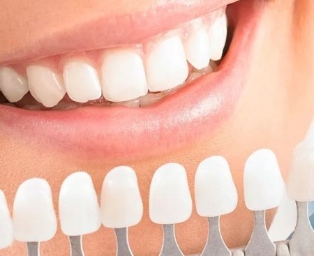 На сколько тонов возможно отбелить зубы?